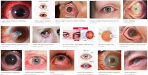 Ваксино-свързан увеит